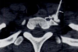 CT-guided stellate ganglion injection. Image courtesy of the RSNA.