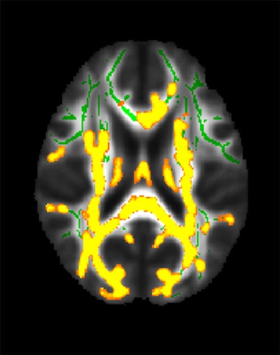 This figure shows increased neuroinflammation (yellow colors) associated with higher hidden fat (visceral fat) in the cohort of 54 participants with an average age of 50 years in the brain’s white matter. The green colors are the normal white matter. Image courtesy of the RSNA.