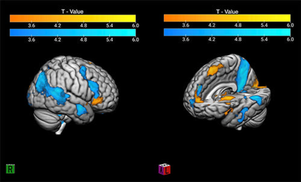 The contrast of winning and losing in the 'good fanatic brain.' The image shows in warm colors the activity related to a significant victory. The blue scale represents the activation related to a significant loss; this pattern is congruent with the Mentalization Network, which suggests a rationalization process of the pain evoked by the losing scenario. Image and caption courtesy of the RSNA.