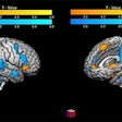 The contrast of winning and losing in the 'good fanatic brain.' The image shows in warm colors the activity related to a significant victory. The blue scale represents the activation related to a significant loss; this pattern is congruent with the Mentalization Network, which suggests a rationalization process of the pain evoked by the losing scenario. Image and caption courtesy of the RSNA.