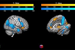 The contrast of winning and losing in the 'good fanatic brain.' The image shows in warm colors the activity related to a significant victory. The blue scale represents the activation related to a significant loss; this pattern is congruent with the Mentalization Network, which suggests a rationalization process of the pain evoked by the losing scenario. Image and caption courtesy of the RSNA.