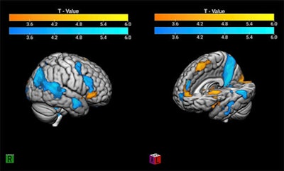 The contrast of winning and losing in the 'good fanatic brain.' The image shows in warm colors the activity related to a significant victory. The blue scale represents the activation related to a significant loss; this pattern is congruent with the Mentalization Network, which suggests a rationalization process of the pain evoked by the losing scenario. Image and caption courtesy of the RSNA.