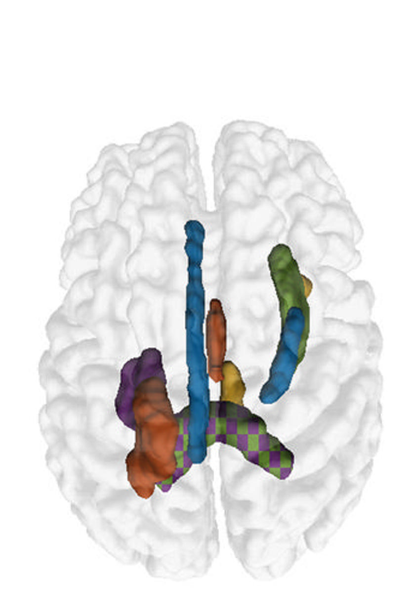 The top five white matter features (region pairs) in a single image. The color map is: yellow = superior cerebellar peduncle (R)/uncinate fasciculus (R), orange = column and body of fornix/posterior corona radiata (L), purple = splenium/retrolenticular internal capsule (L), blue = dorsal cingulum (L)/cres of fornix (R), green = splenium/external capsule (R). Image and caption courtesy of the RSNA.