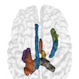 The top five white matter features (region pairs) in a single image. The color map is: yellow = superior cerebellar peduncle (R)/uncinate fasciculus (R), orange = column and body of fornix/posterior corona radiata (L), purple = splenium/retrolenticular internal capsule (L), blue = dorsal cingulum (L)/cres of fornix (R), green = splenium/external capsule (R). Image and caption courtesy of the RSNA.