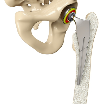 3 D Hip Replacement 400