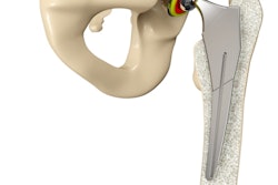 3 D Hip Replacement 400