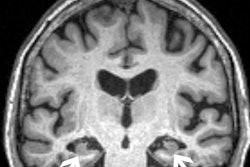 A brain MRI in patient with mild cognitive impairment. Image courtesy of Joshua Wibecan, MD.