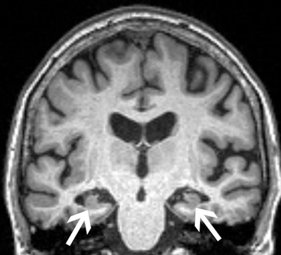 A brain MRI in patient with mild cognitive impairment. Image courtesy of Joshua Wibecan, MD.
