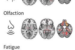 Brain regions in which the microstructure was associated with post-COVID-condition associated symptoms. Image courtesy of Alexander Rau, MD.
