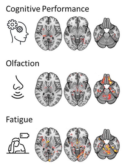 Brain regions in which the microstructure was associated with post-COVID-condition associated symptoms. Image courtesy of Alexander Rau, MD.