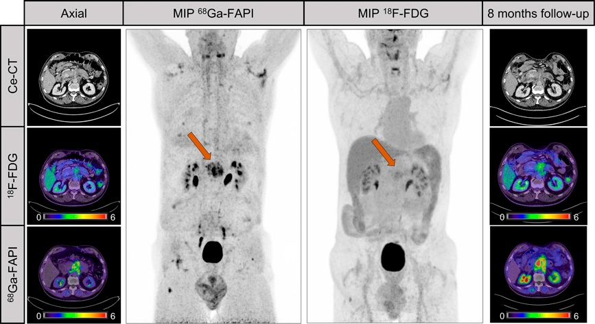A male patient with suspected recurrent pancreatic cancer. Contrast-enhanced CT shows mass around superior mesenteric artery after pancreatectomy. F-18 FDG only shows discrete uptake of lesion (SUVmax, 3.8), whereas Ga-68 FAPI clearly visualizes recurrent tumor. Patient received adjuvant chemotherapy after Ga-68 FAPI. Patient denied recommended chemotherapy. Increase of CA19-9 levels (from 240 U/mL to 767 U/mL) and follow-up imaging eight months later validated progression of mesenteric mass as well as increased F-18 FDG uptake (SUVmax, 5.3). Image courtesy of the Journal of Nuclear Medicine.
