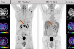 A male patient with suspected recurrent pancreatic cancer. Contrast-enhanced CT shows mass around superior mesenteric artery after pancreatectomy. F-18 FDG only shows discrete uptake of lesion (SUVmax, 3.8), whereas Ga-68 FAPI clearly visualizes recurrent tumor. Patient received adjuvant chemotherapy after Ga-68 FAPI. Patient denied recommended chemotherapy. Increase of CA19-9 levels (from 240 U/mL to 767 U/mL) and follow-up imaging eight months later validated progression of mesenteric mass as well as increased F-18 FDG uptake (SUVmax, 5.3). Image courtesy of the Journal of Nuclear Medicine.