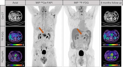 A male patient with suspected recurrent pancreatic cancer. Contrast-enhanced CT shows mass around superior mesenteric artery after pancreatectomy. F-18 FDG only shows discrete uptake of lesion (SUVmax, 3.8), whereas Ga-68 FAPI clearly visualizes recurrent tumor. Patient received adjuvant chemotherapy after Ga-68 FAPI. Patient denied recommended chemotherapy. Increase of CA19-9 levels (from 240 U/mL to 767 U/mL) and follow-up imaging eight months later validated progression of mesenteric mass as well as increased F-18 FDG uptake (SUVmax, 5.3). Image courtesy of the Journal of Nuclear Medicine.