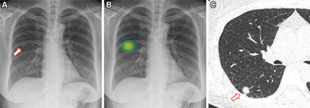An example of a patient frontal chest x-ray showing a subtle nodular opacity (arrow) identified by AI in the right middle lung zone. Axial, noncontrast, low-dose chest CT scan shows a 1.1-cm solid nodule (arrow) in the right lower lobe. Image courtesy of Anika Walia, Boston University