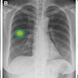 An example of a patient frontal chest x-ray showing a subtle nodular opacity (arrow) identified by AI in the right middle lung zone. Axial, noncontrast, low-dose chest CT scan shows a 1.1-cm solid nodule (arrow) in the right lower lobe. Image courtesy of Anika Walia, Boston University