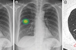 An example of a patient frontal chest x-ray showing a subtle nodular opacity (arrow) identified by AI in the right middle lung zone. Axial, noncontrast, low-dose chest CT scan shows a 1.1-cm solid nodule (arrow) in the right lower lobe. Image courtesy of Anika Walia, Boston University