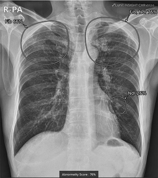 A true positive case in a 72-year-old male with a granuloma on chest x-ray after visiting the neurology outpatient clinic for memory disturbance. A small lung nodule was detected in the left-middle to lower lung field by AI software, with an abnormality score of 26%. Co-existing fibrosis was suspected in the apex of bilateral upper lungs, with an abnormality score of 76%. Image courtesy of Scientific Reports.