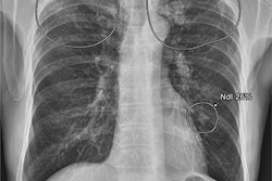 A true positive case in a 72-year-old male with a granuloma on chest x-ray after visiting the neurology outpatient clinic for memory disturbance. A small lung nodule was detected in the left-middle to lower lung field by AI software, with an abnormality score of 26%. Co-existing fibrosis was suspected in the apex of bilateral upper lungs, with an abnormality score of 76%. Image courtesy of Scientific Reports.