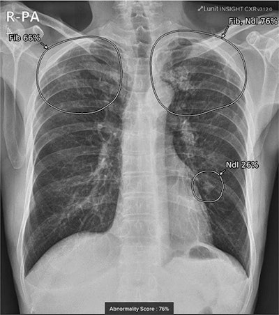 A true positive case in a 72-year-old male with a granuloma on chest x-ray after visiting the neurology outpatient clinic for memory disturbance. A small lung nodule was detected in the left-middle to lower lung field by AI software, with an abnormality score of 26%. Co-existing fibrosis was suspected in the apex of bilateral upper lungs, with an abnormality score of 76%. Image courtesy of Scientific Reports.