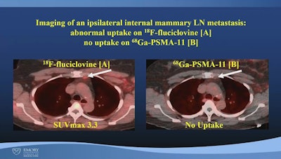 An image from Mushtaq's presentation showing a comparison between PET radiotracers in a patient with ILC. Image courtesy of Aliza Mushtaq, MD, Emory University. An image from Mushtaq's presentation showing a comparison between PET radiotracers in a patient with ILC. Image courtesy of Aliza Mushtaq, MD, Emory University.