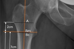 An example of measurement on plain anterior-posterior x-rays used in the study: canal-bone-ratio CBR-7 cm (Cm/Cc) and CBR-10 cm (Dm/Dc), canal-calcar ratio CCR (Dm/Bm); canal flare index CFI (A/Dm). Image courtesy of Scientific Reports.