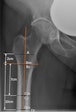 An example of measurement on plain anterior-posterior x-rays used in the study: canal-bone-ratio CBR-7 cm (Cm/Cc) and CBR-10 cm (Dm/Dc), canal-calcar ratio CCR (Dm/Bm); canal flare index CFI (A/Dm). Image courtesy of Scientific Reports.