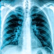Chest Lung Xray 400