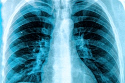 Chest Lung Xray 400