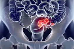 Colorectal Cancer