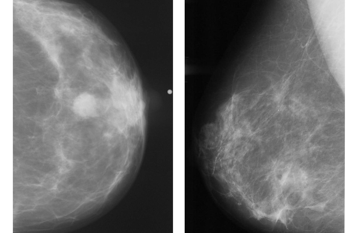 Abnormal mammogram, left. Normal mammogram, right. Images and caption courtesy of RSNA.