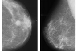 Abnormal mammogram, left. Normal mammogram, right. Images and caption courtesy of RSNA.