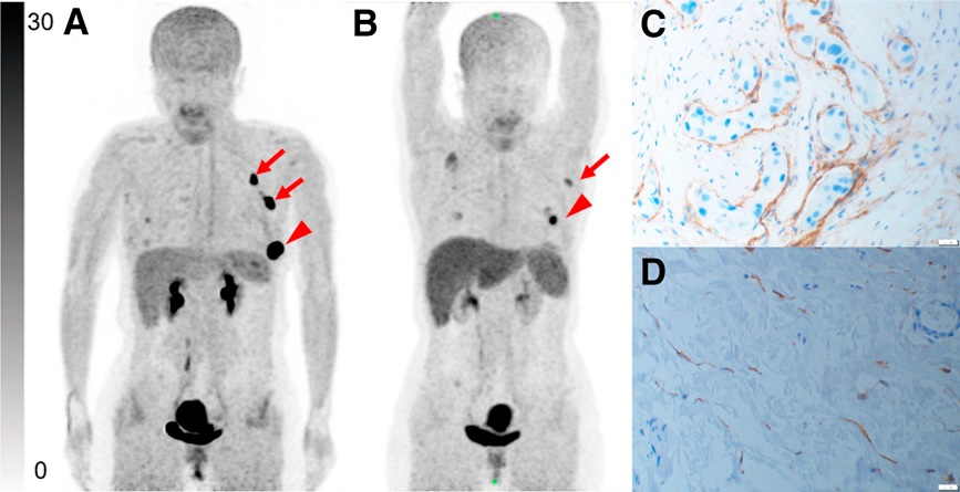 Representative Ga-68 FAPI-PET/CT images of 48-year-old woman who had left invasive ductal carcinoma and who achieved pathologic complete response (pCR). (A) Baseline maximum-intensity projection (MIP) image demonstrated primary lesion (red arrowhead; SUVmax, 26.72) and Ga-68 FAPI-avid lymph node in left axilla (red arrows). (B) MIP image after two cycles of neoadjuvant chemotherapy (NAC) showed that primary lesion (red arrowhead; SUVmax, 8.87) and axillary lymph nodes (red arrow) were reduced in size and radioactivity uptake. (C and D) Representative images of lab tissue staining for FAP before NAC showed strong FAP-positive staining in stromal cells (C), which was significantly decreased on tumor bed after six cycles of NAC (D). Image courtesy of the Journal of Nuclear Medicine.