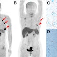 Representative Ga-68 FAPI-PET/CT images of 48-year-old woman who had left invasive ductal carcinoma and who achieved pathologic complete response (pCR). (A) Baseline maximum-intensity projection (MIP) image demonstrated primary lesion (red arrowhead; SUVmax, 26.72) and Ga-68 FAPI-avid lymph node in left axilla (red arrows). (B) MIP image after two cycles of neoadjuvant chemotherapy (NAC) showed that primary lesion (red arrowhead; SUVmax, 8.87) and axillary lymph nodes (red arrow) were reduced in size and radioactivity uptake. (C and D) Representative images of lab tissue staining for FAP before NAC showed strong FAP-positive staining in stromal cells (C), which was significantly decreased on tumor bed after six cycles of NAC (D). Image courtesy of the Journal of Nuclear Medicine.
