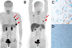 Representative Ga-68 FAPI-PET/CT images of 48-year-old woman who had left invasive ductal carcinoma and who achieved pathologic complete response (pCR). (A) Baseline maximum-intensity projection (MIP) image demonstrated primary lesion (red arrowhead; SUVmax, 26.72) and Ga-68 FAPI-avid lymph node in left axilla (red arrows). (B) MIP image after two cycles of neoadjuvant chemotherapy (NAC) showed that primary lesion (red arrowhead; SUVmax, 8.87) and axillary lymph nodes (red arrow) were reduced in size and radioactivity uptake. (C and D) Representative images of lab tissue staining for FAP before NAC showed strong FAP-positive staining in stromal cells (C), which was significantly decreased on tumor bed after six cycles of NAC (D). Image courtesy of the Journal of Nuclear Medicine.
