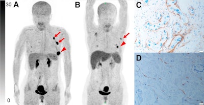Representative Ga-68 FAPI-PET/CT images of 48-year-old woman who had left invasive ductal carcinoma and who achieved pathologic complete response (pCR). (A) Baseline maximum-intensity projection (MIP) image demonstrated primary lesion (red arrowhead; SUVmax, 26.72) and Ga-68 FAPI-avid lymph node in left axilla (red arrows). (B) MIP image after two cycles of neoadjuvant chemotherapy (NAC) showed that primary lesion (red arrowhead; SUVmax, 8.87) and axillary lymph nodes (red arrow) were reduced in size and radioactivity uptake. (C and D) Representative images of lab tissue staining for FAP before NAC showed strong FAP-positive staining in stromal cells (C), which was significantly decreased on tumor bed after six cycles of NAC (D). Image courtesy of the Journal of Nuclear Medicine.