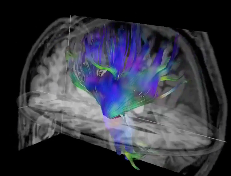 Researchers used diffusion tensor imaging, an MRI technique, to study the impact of soccer heading on the brain. This method tracks the microscopic movement of water molecules through brain tissue to characterize the brain's microstructure. Image and caption courtesy of the RSNA.