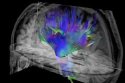 Researchers used diffusion tensor imaging, an MRI technique, to study the impact of soccer heading on the brain. This method tracks the microscopic movement of water molecules through brain tissue to characterize the brain's microstructure. Image and caption courtesy of the RSNA.
