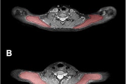 Trapezius muscle segmentations show (A) segmentation masks of the bilateral trapezius muscles (red areas) in a 25-year-old female and (B) in a 24-year-old male. Images and caption courtesy of the RSNA.