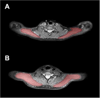 Trapezius muscle segmentations show (A) segmentation masks of the bilateral trapezius muscles (red areas) in a 25-year-old female and (B) in a 24-year-old male. Images and caption courtesy of the RSNA.