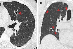 CT images show airway changes in a 66-year-old male marijuana and tobacco smoker with cylindrical bronchiectasis and bronchial wall thickening (arrowheads) in multiple lung lobes in a background of paraseptal and centrilobular emphysema. Image and caption courtesy of the RSNA.