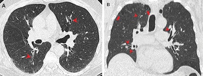 CT images show airway changes in a 66-year-old male marijuana and tobacco smoker with cylindrical bronchiectasis and bronchial wall thickening (arrowheads) in multiple lung lobes in a background of paraseptal and centrilobular emphysema. Image and caption courtesy of the RSNA.