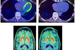 Heart and brain PET scans from a study participant who developed Parkinson’s disease support a “body first” progression. The top pair of PET scan images show low F-18 dopamine-derived radioactivity in the heart (right, with N-13 ammonia PET scan on left). Later, brain scans showed a loss of dopamine-producing neurons and the individual developed symptoms of the disease. Image courtesy of the National Institutes of Health.