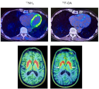 Heart and brain PET scans from a study participant who developed Parkinson’s disease support a “body first” progression. The top pair of PET scan images show low F-18 dopamine-derived radioactivity in the heart (right, with N-13 ammonia PET scan on left). Later, brain scans showed a loss of dopamine-producing neurons and the individual developed symptoms of the disease. Image courtesy of the National Institutes of Health.