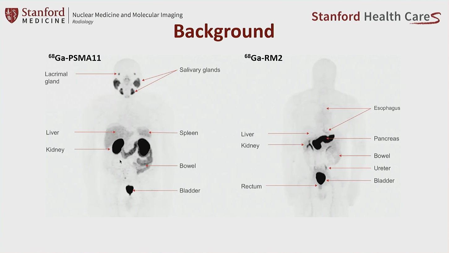 An image showing potentially different sites of PET radiotracer uptake by prostate cancer tumors between U.S. approved Ga-68 PSMA-PET and experimental Ga-68 RM2. Image courtesy of Heying Duan, MD, Stanford University.