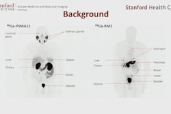 An image showing potentially different sites of PET radiotracer uptake by prostate cancer tumors between U.S. approved Ga-68 PSMA-PET and experimental Ga-68 RM2. Image courtesy of Heying Duan, MD, Stanford University.