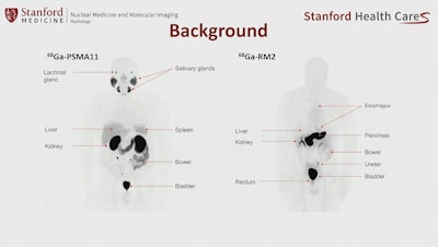 An image showing potentially different sites of PET radiotracer uptake by prostate cancer tumors between U.S. approved Ga-68 PSMA-PET and experimental Ga-68 RM2. Image courtesy of Heying Duan, MD, Stanford University.