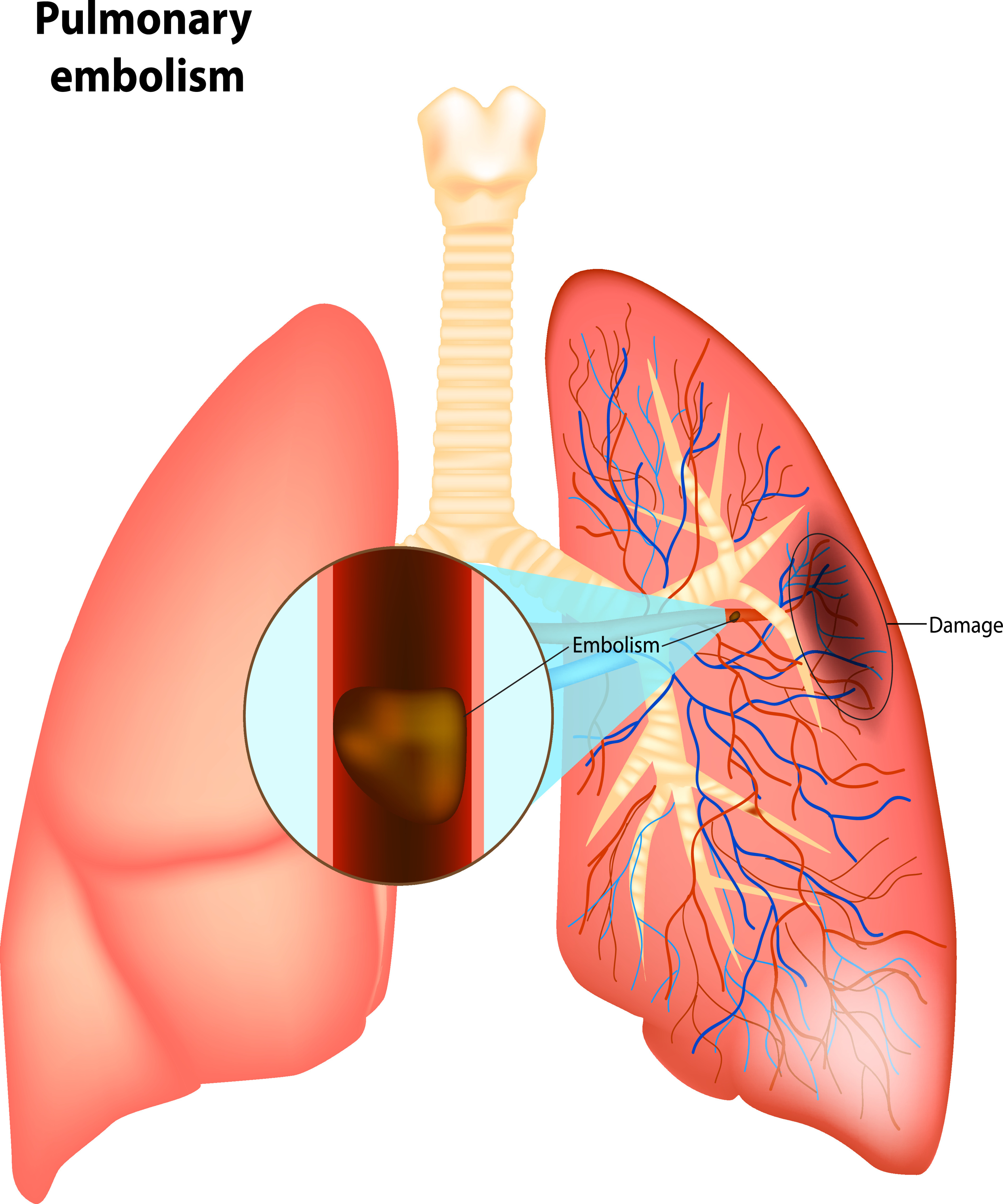 Pulmonary Embolism Illustration