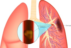 Pulmonary Embolism Illustration