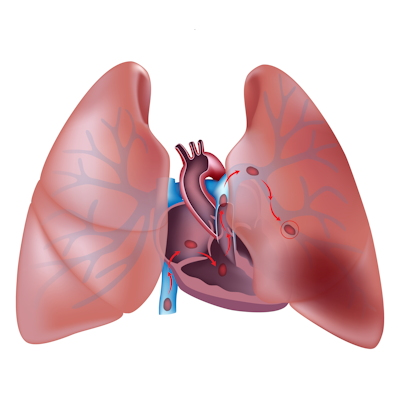Pulmonary Embolism Illustration V2 400