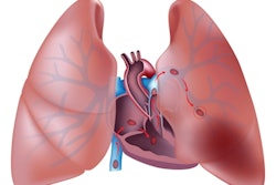 Pulmonary Embolism Illustration V2 400
